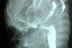 perforacion-gastrica-estomago-pleuritis-derrame-pleural-izq-003