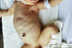 perforacion-gastrica-neumoperitoneo-distension-abdominal-002