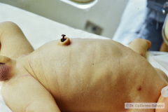 perforacion-gastrica-neumoperitoneo-distension-abdominal-004