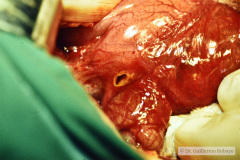 perforacion-gastrica-neumoperitoneo-distension-abdominal-008