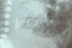 peritonitis-meconial-1998-000