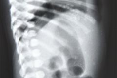 peritonitis-meconial-2000-002