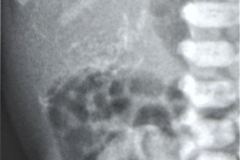 peritonitis-meconial-2000-003