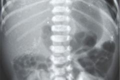peritonitis-meconial-2000-004