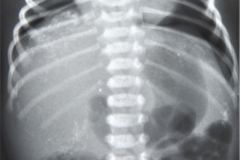 peritonitis-meconial-2000-006