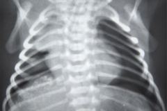 peritonitis-meconial-2000-007