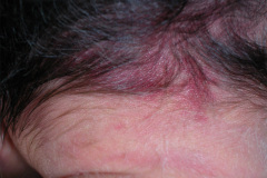 picotazo-ciguena-mancha-salmon-nevus-flamemeus-nucal-2009-000
