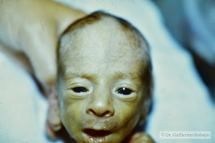 piebaldismo-poliosis-pelo-blanco-000