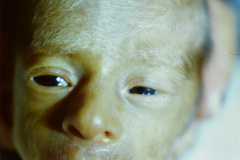 piebaldismo-poliosis-pelo-blanco-002