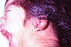 pierre-robin-2004-000