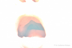 pierre-robin-asociada-a-anomalia-tibia-000