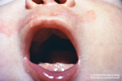 pierre-robin-asociada-a-anomalia-tibia-002