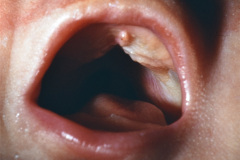 pierre-robin-asociada-a-anomalia-tibia-003