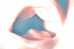 pierre-robin-asociada-a-anomalia-tibia-005