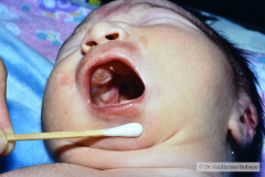 pierre-robin-asociada-a-anomalia-tibia-006