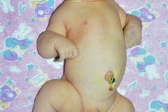 pierre-robin-asociada-a-anomalia-tibia-007