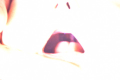pierre-robin-micrognatia-glosoptosis-paladar-hendido-central-posterior-002