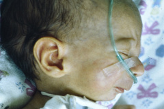 pierre-robin-traqueostomia-gastrostomia-001
