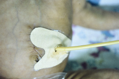 pierre-robin-traqueostomia-gastrostomia-002