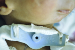 pierre-robin-traqueostomia-gastrostomia-005