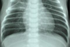 pliegue-cutaneo-abdominal-se-confunde-con-neumoperitoneo-000