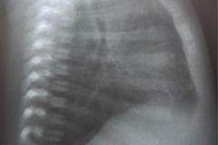 pliegues-cutaneos-torax-se-confnden-con-neumotorax-1991-000
