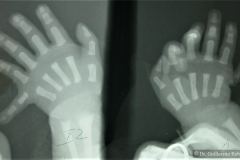 polidactilia-postaxial-5-dedo-mano-bil-1986-001