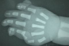 polidactilia-postaxial-5-dedo-mano-bil-1990-000