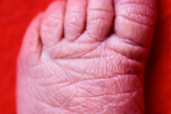 polidactilia-preaxial-mano-der-1986-003