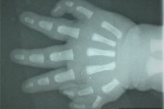polidactilia-preaxial-mano-der-1990-000