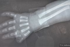 polidactilia-preaxial-mano-der-1992-000