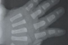 polidactilia-preaxial-mano-der-1994-000
