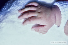 polidactilia-preaxial-mano-der-1994-003