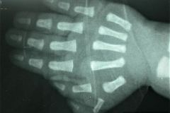 polidactilia-preaxial-mano-der-1996-000