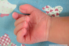 polidactilia-preaxial-mano-der-2000-000