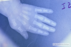 polidactilia-preaxial-mano-der-000