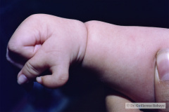 polidactilia-preaxial-mano-der-002