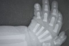 polidactilia-preaxial-mano-izq-1994-001