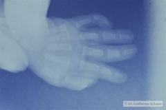 polidactilia-preaxial-mano-izq-1997-000