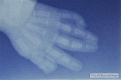 polidactilia-preaxial-mano-izq-1997-001