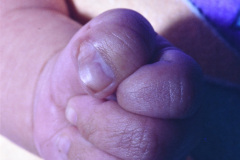 polidactilia-preaxial-mano-izq-1997-008