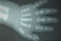 polidactilia-preaxial-mano-izq-1999-000