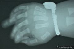 polidactilia-preaxial-mano-izq-amuleto-constrictivo-mano-der-000