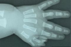 polidactilia-preaxial-mano-izq-amuleto-constrictivo-mano-der-001