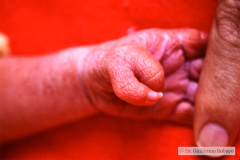polidactilia-preaxial-mano-izq-000