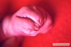 polidactilia-preaxial-mano-izq-002