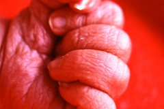 polidactilia-preaxial-mano-izq-003