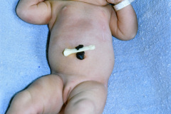 poliosis-pelo-blanco-001