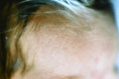 poliosis-pelo-blanco-009