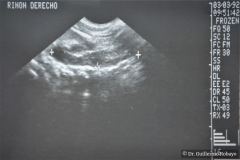 poliquistosis-renal-autosomica-dominante-rinon-poliquistico-bil-ecografia-rn2m-urograia-cistografia-gamagrafia-10-1992-000